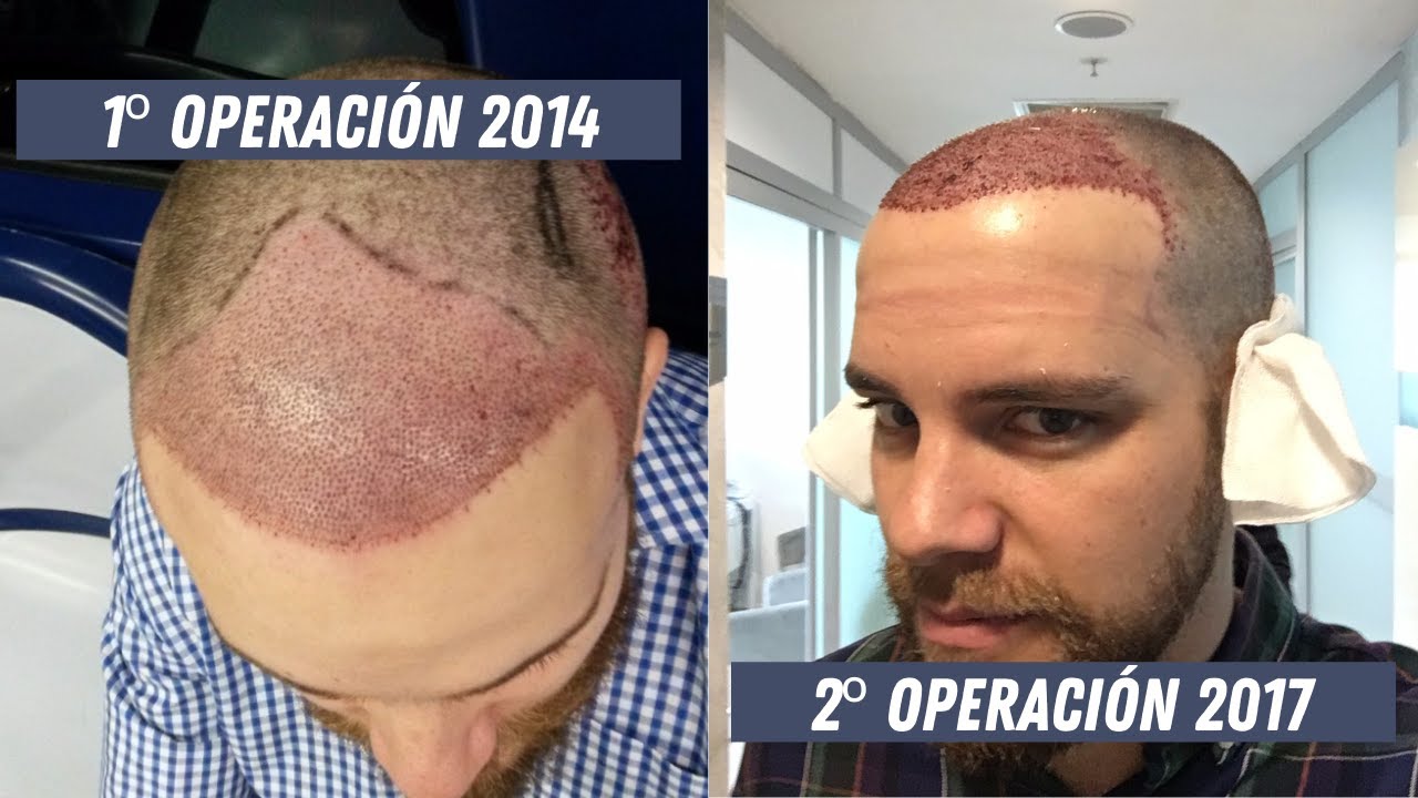 ¿POR QUÉ ME HE OPERADO 2 VECES?
