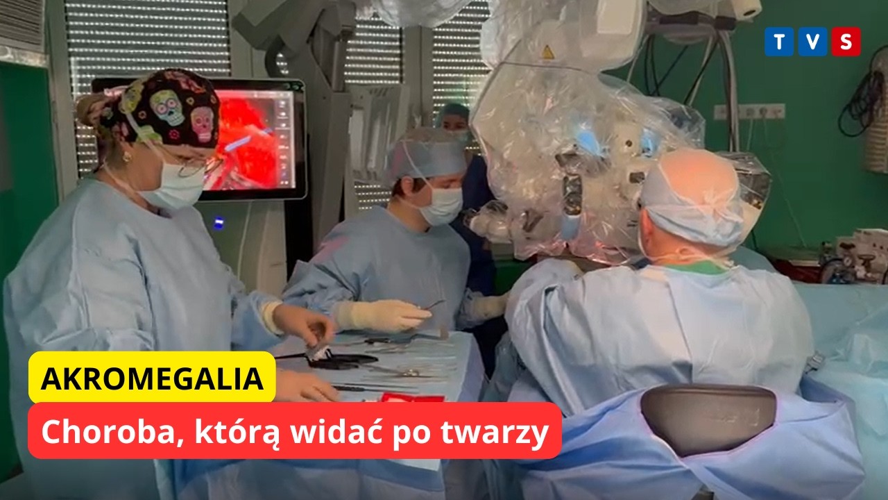 Akromegalia – choroba, którą widać po twarzy
