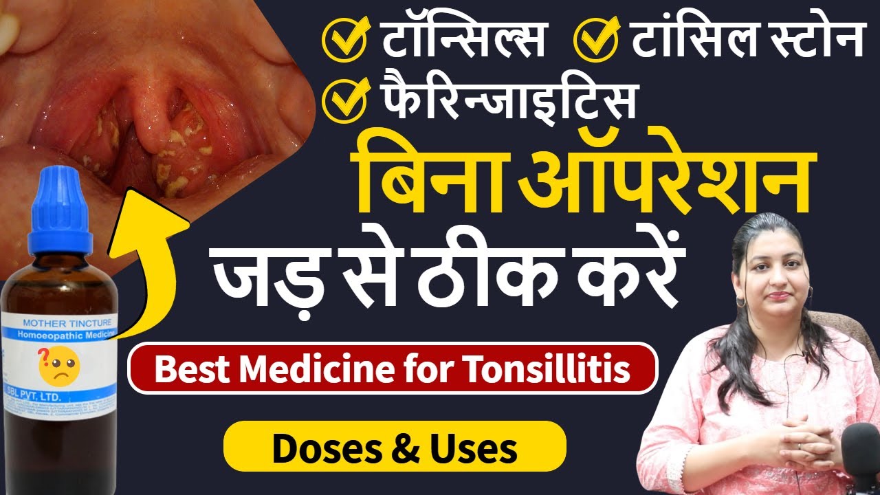 बिना ऑपरेशन Tonsillitis कैसे ठीक होगा | Best Medicine for Tonsillitis, Tonsil Stones and Pharyngitis