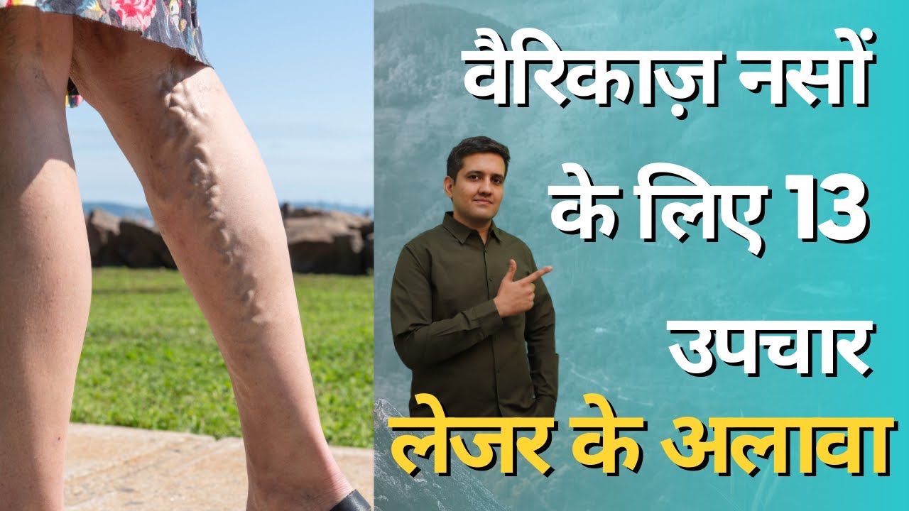 13 Non surgical treatment options for varicose veins | Varicose Veins in Hindi | Dr. Gaurav Gangwani