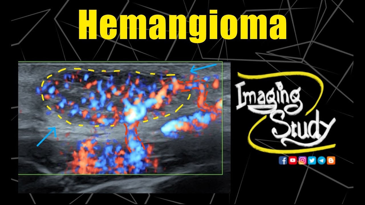 Superficial Hemangioma || Ultrasound || Doppler || Case 309