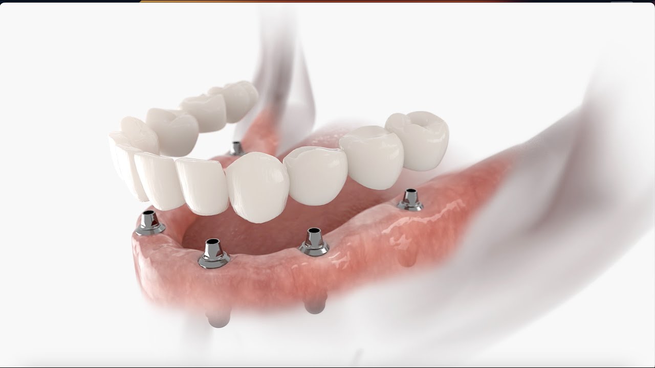 All-on-6 Implantes Dentários - Arco Inferior / All-on-6 Dental Implants - Lower Arch.