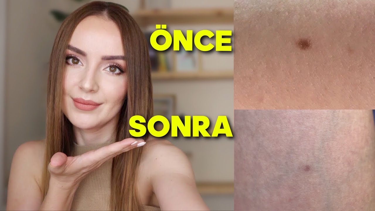 5 DAKİKADA BEN ALDIRDIM | Öncesi sonrası ve bilmeniz gerekenler