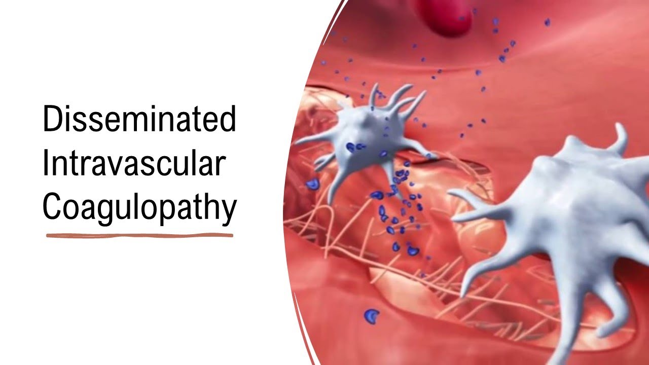 Disseminated Intravascular Coagulopathy (DIC)