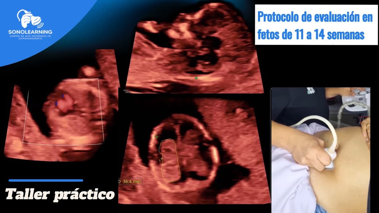 ECOGRAFIA 11 - 14 SEMANAS #embarazo #fetalmedicine #obstetricia #docencia #ense&ntilde;anza #ecografia