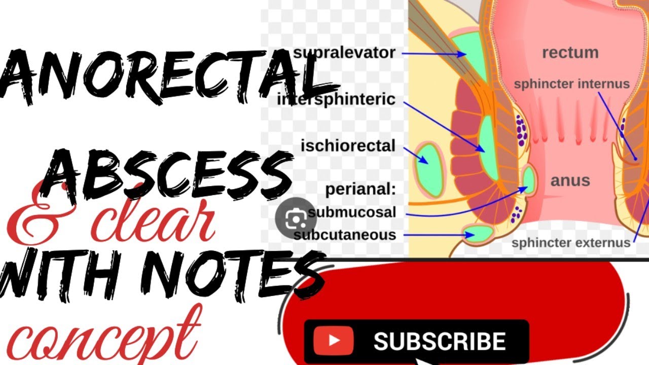 Anorectalabscess#bams4thyr#shalya#notes#easy#explanation#ayurveda 