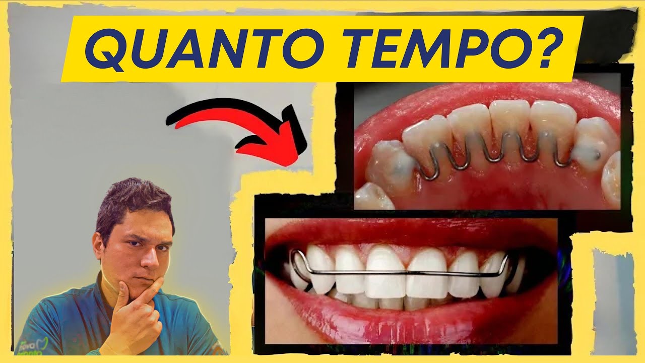 POR QUANTO TEMPO SE DEVE USAR A CONTEN&Ccedil;&Atilde;O ORTOD&Ocirc;NTICA?