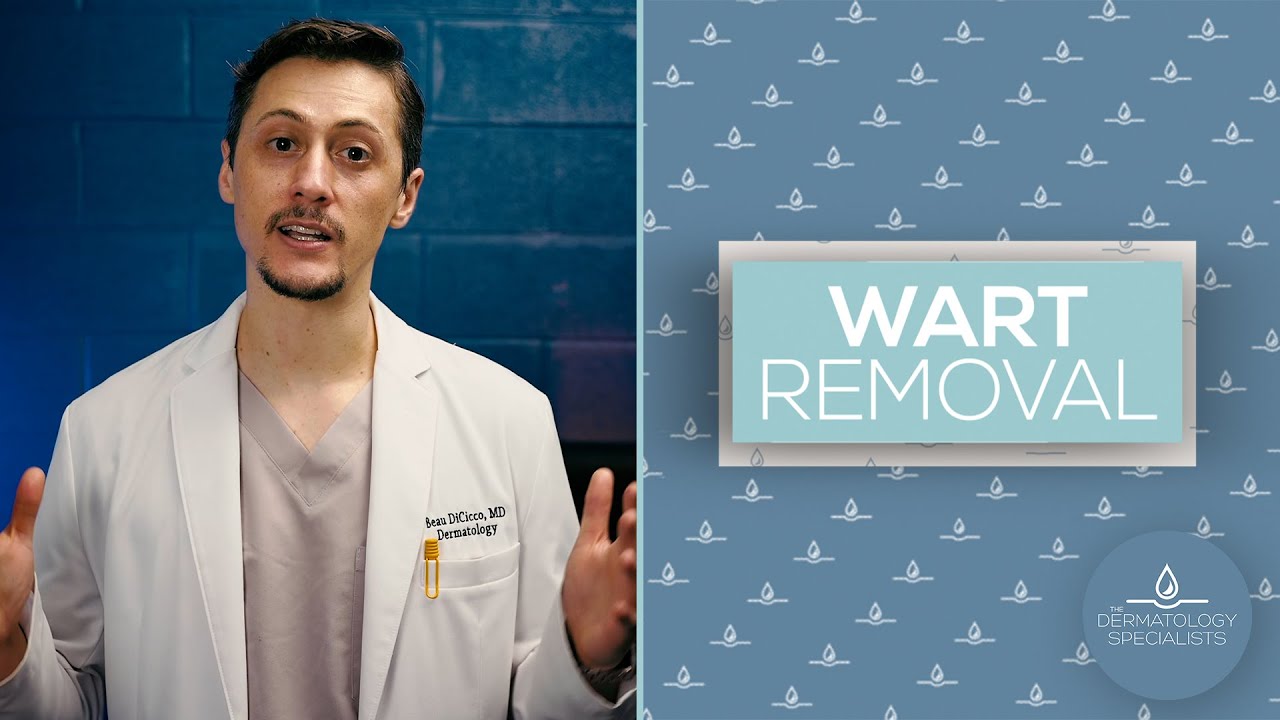 Wart Removal