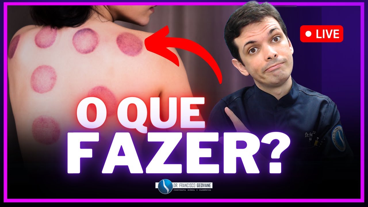 REAÇÕES À VENTOSATERAPIA (PARTE 01) - O Que Fazer QUANDO FICA ROXO? (DEVO ME PREOCUPAR? 😱)