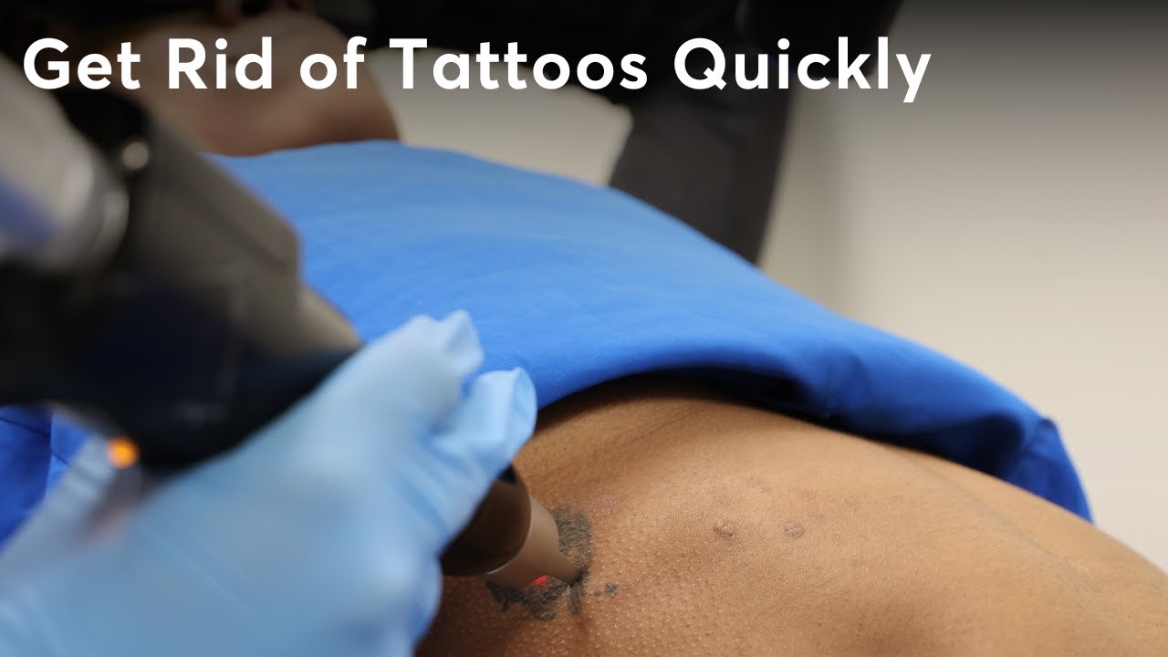 The Compilation of Removing Tattoos: PicoWay and PicoSure Lasers