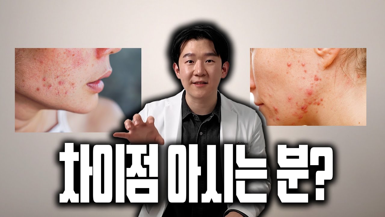 여드름 VS 모낭염 뭐가 다른걸까?