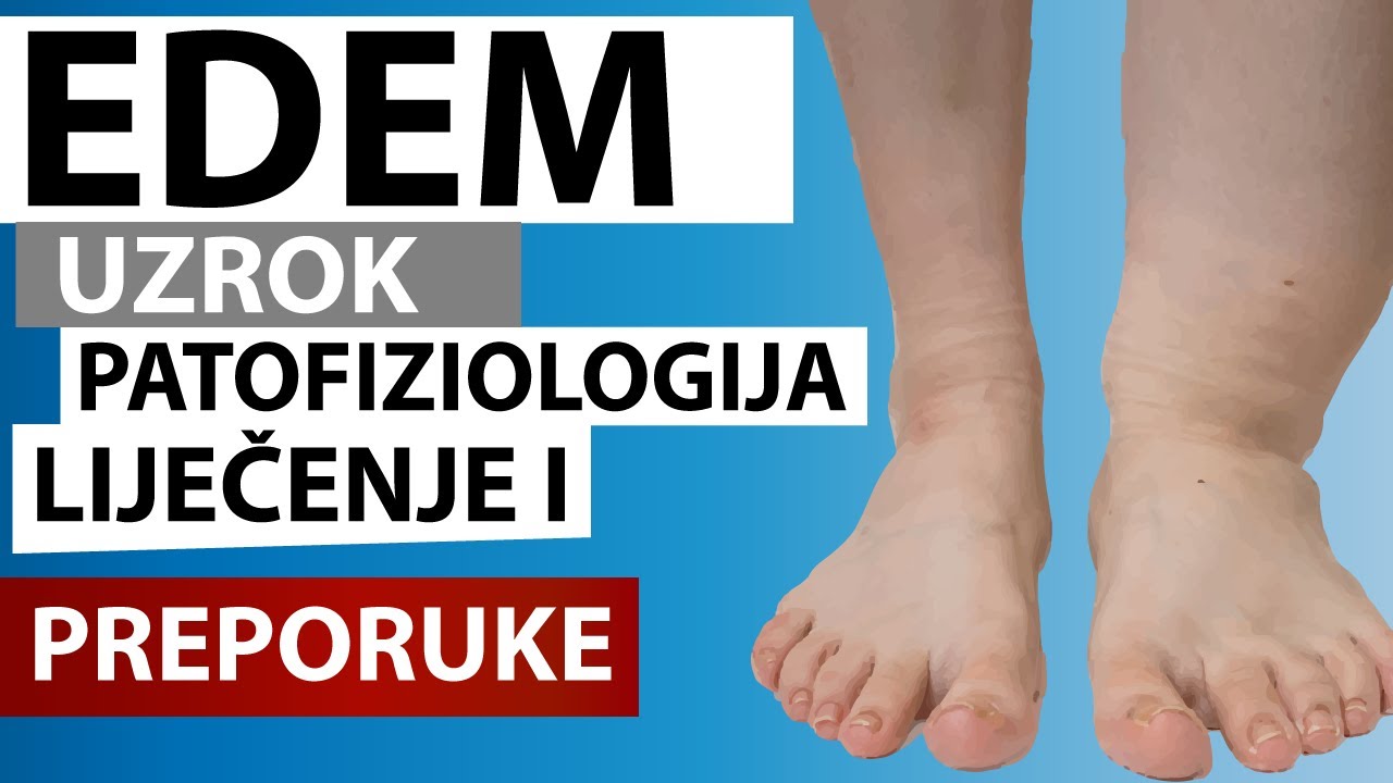 Edem, uzrok, patofiziologija, liječenje i preporuke Dr#62 🏥
