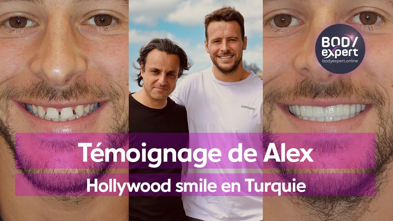 HOLLYWOOD SMILE EN TURQUIE  | 🦷 Témoignage de Alex :  22 couronnes Emax | BODYEXPERT