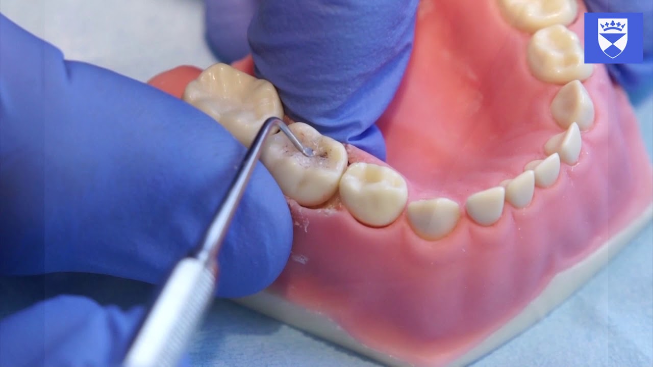 A technique for Atraumatic Restorative Treatment (ART). Part1: Cavity Preparation