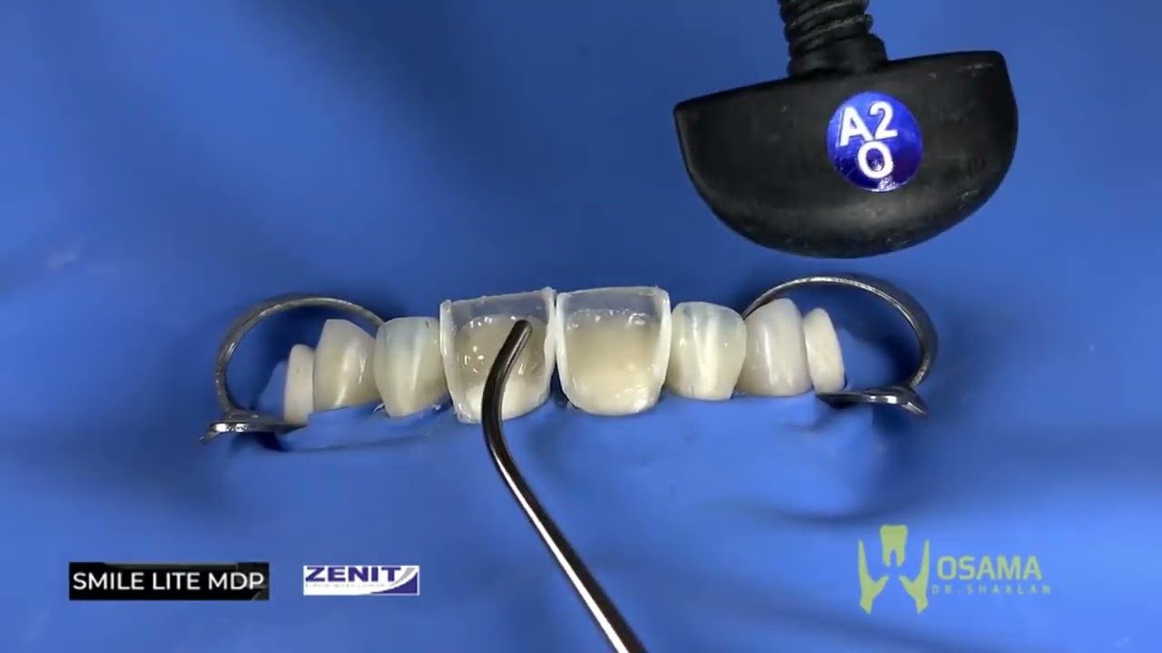 Part 1 layering class iv upper centrals composite restorations #zenit_nanoceramic  Dr. Osama Shaalan