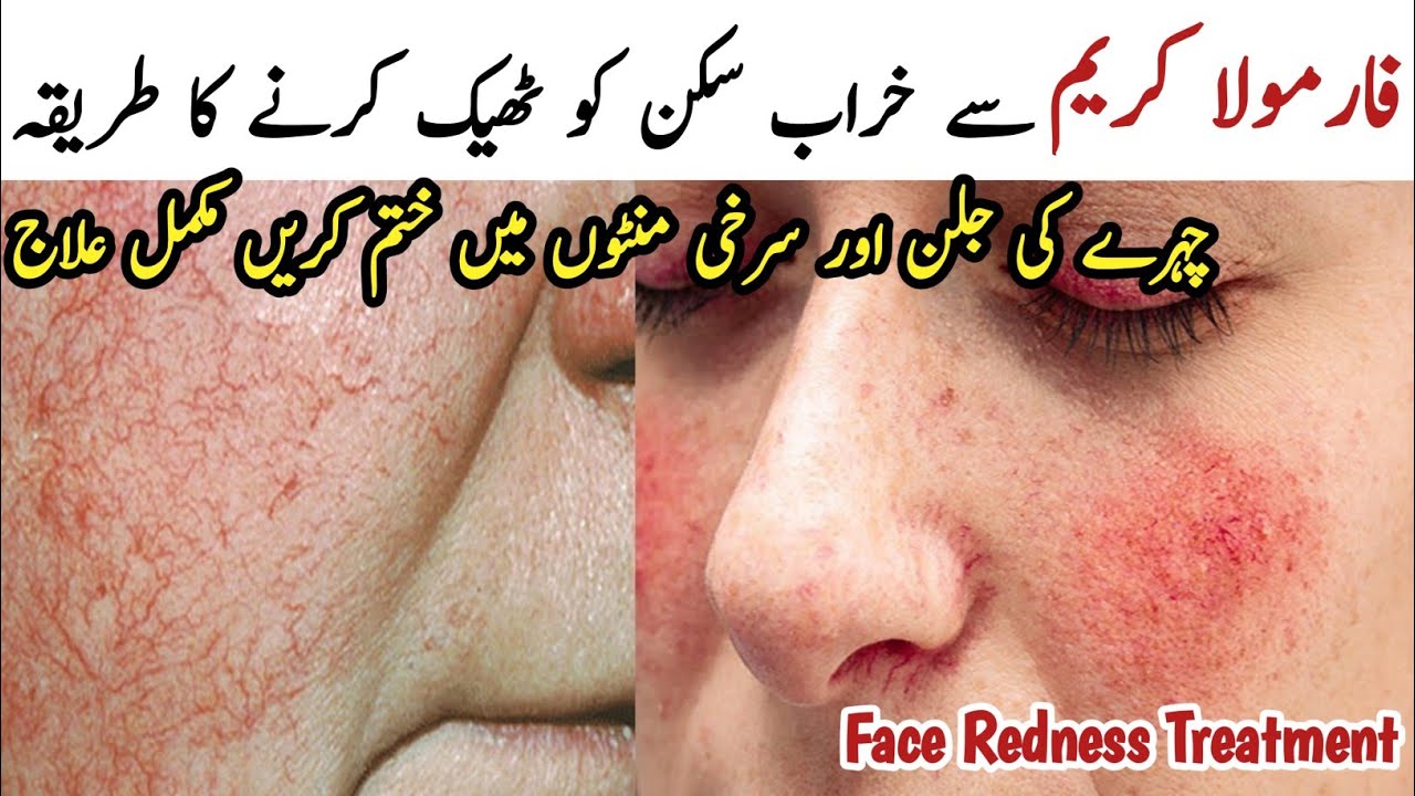 Damage Skin Repair | Chehre Ki Redness Khatam Karne Ka Tarika |Face Redness Treatment by Sanam Irfan