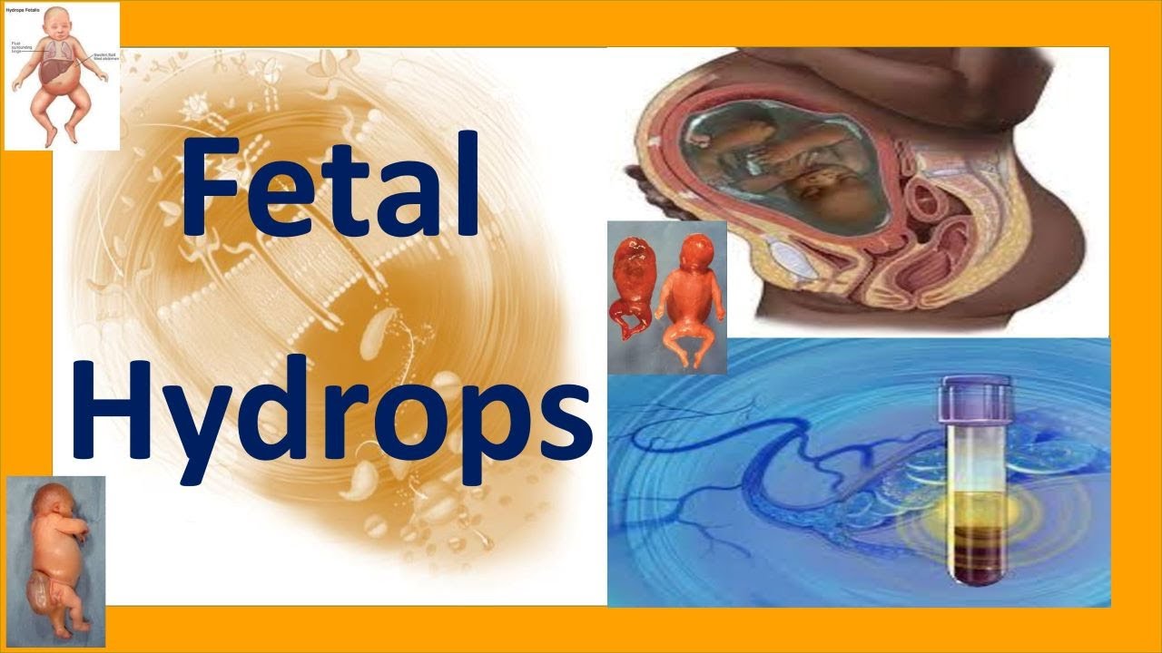 Fetal Hydrops | Hydrops Fetalis | Fetal Hydrops Causes, Complications, Treatment and Prognosis