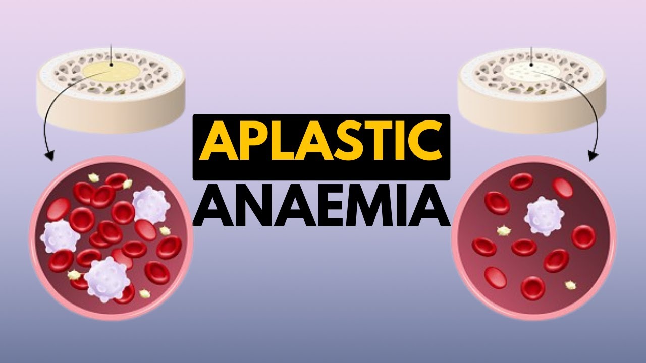 Aplastic Anaemia, Causes, Signs and Symptoms, Diagnosis and Treatment.