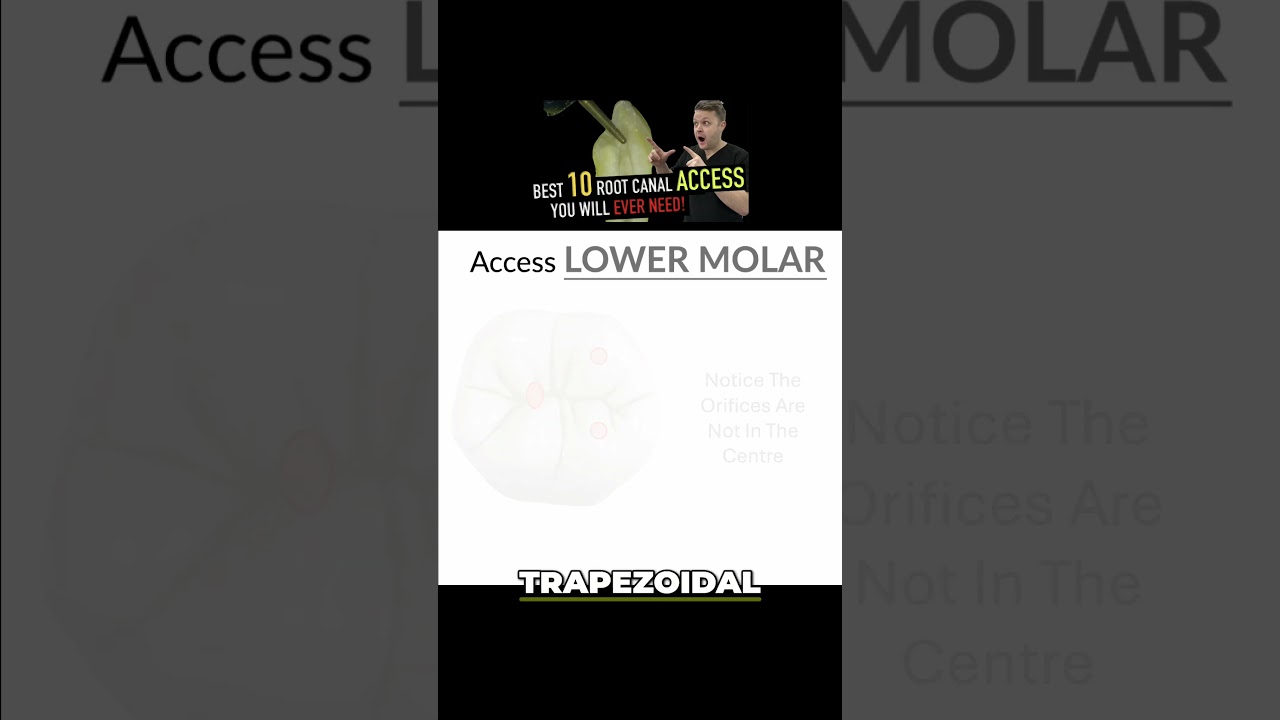 Master the Trapezoid Technique  🎯 Access Dental Success! 🦷