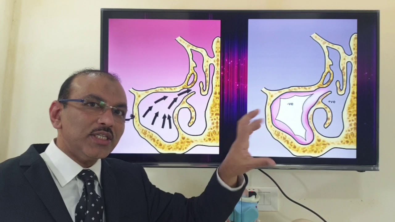 Silent sinus syndrome (English) Patient teaching programme