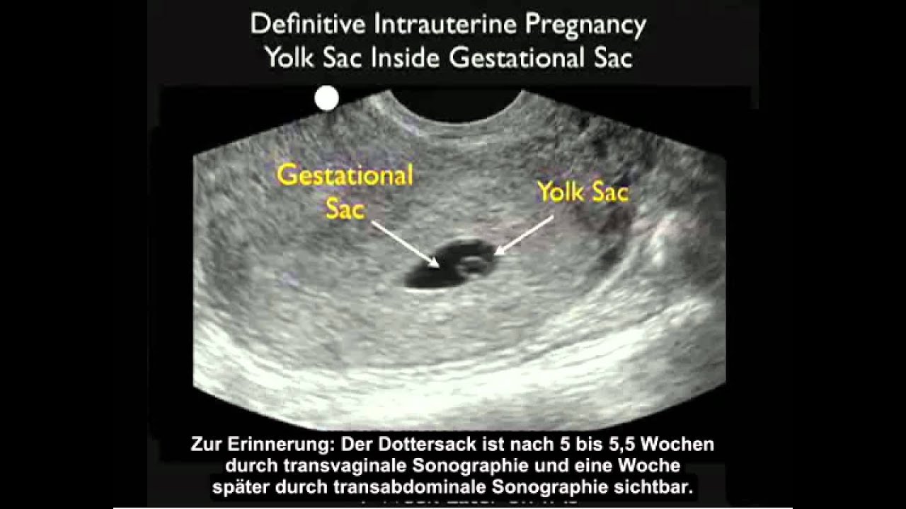 Anleitung: Intrauterine Schwangerschaft – Teil 1