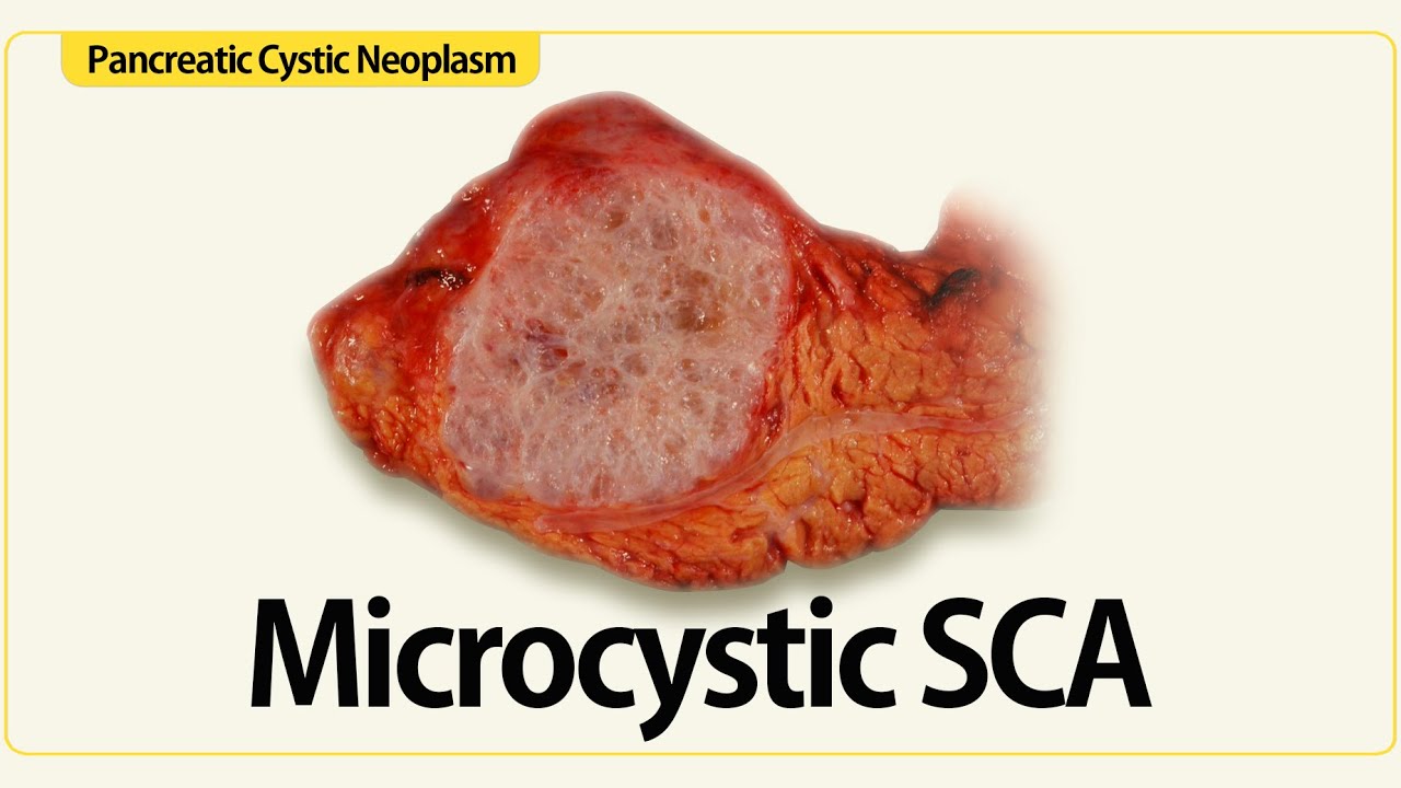 Linear EUS: Microcystic SCA