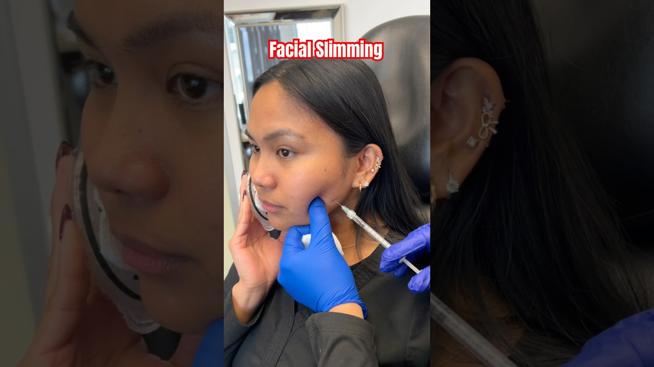 Facial Slimming Injections | Neurotoxin | Masseter Muscle | @doctoryovino #plasticsurgery