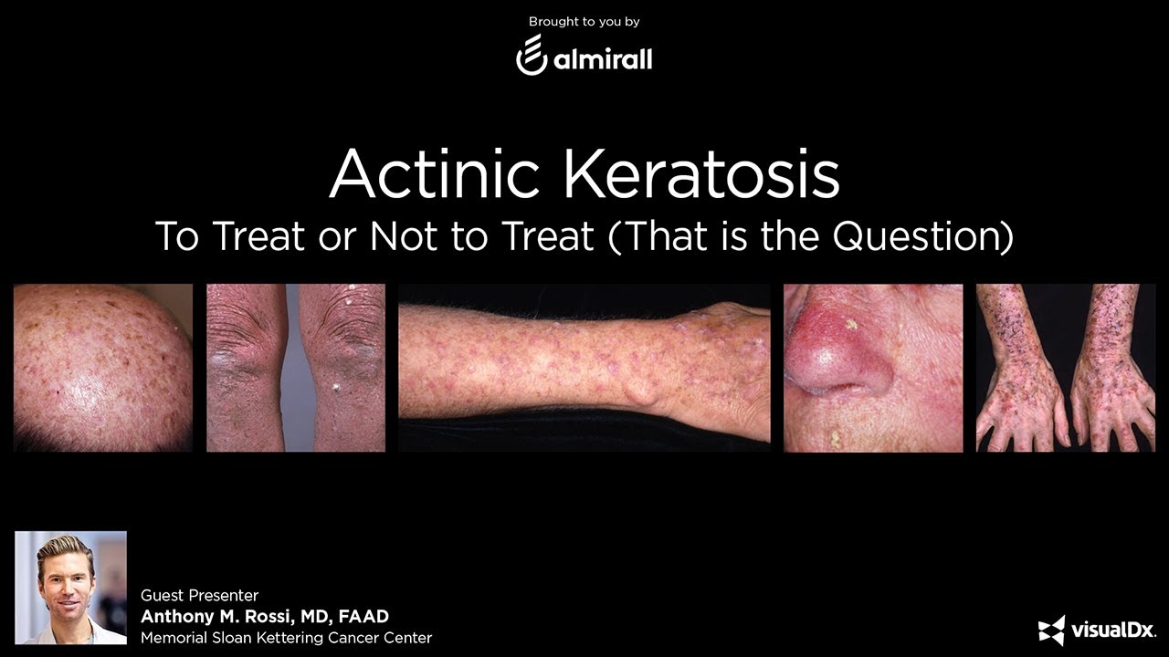 Actinic Keratosis: To Treat or Not to Treat (That is the Question)