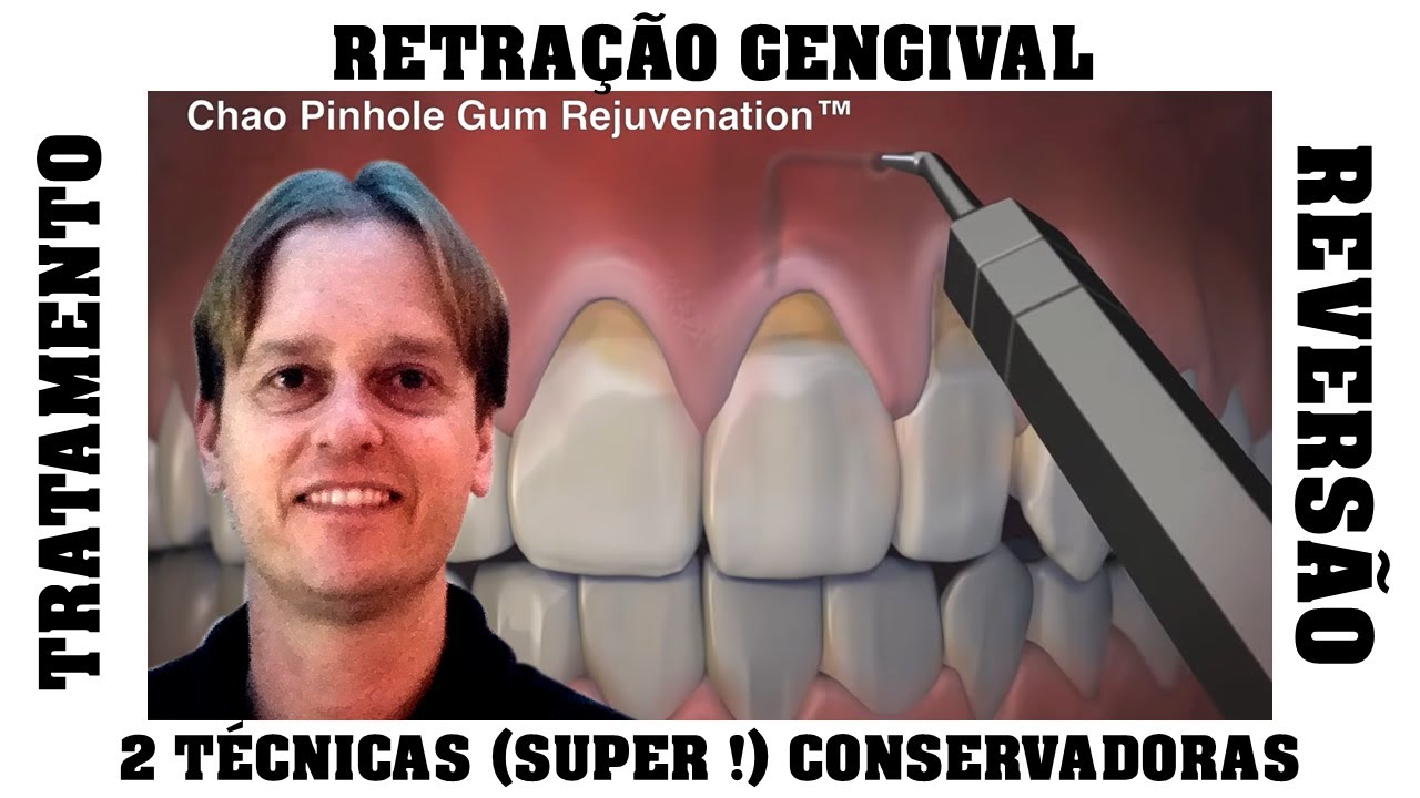 RETRAÇÃO GENGIVAL [Tratamento]: 2 Técnicas de Reversão (Super!) Conservadoras para Recuperar Gengiva