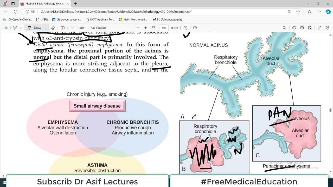 Chp#13 Robbins Patho | Lung Pathology | EMPHYSEMA | Obstructive Lung Diseases
