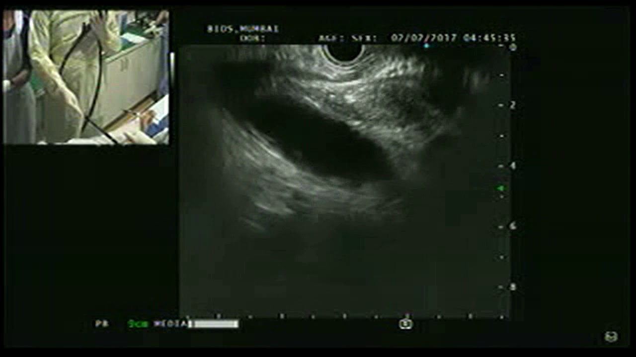 Linear EUS the alpha maneuvre