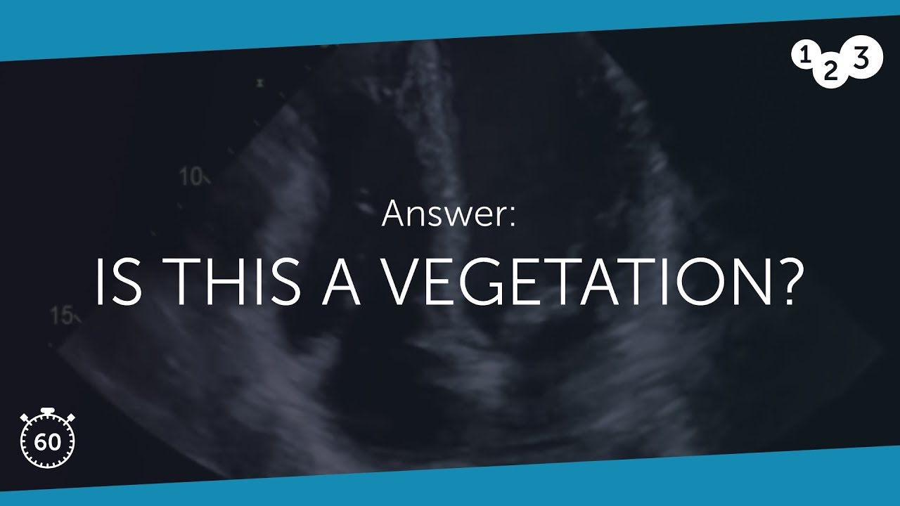 60 Seconds of Echo Teaching Answer: Is this a vegetation?