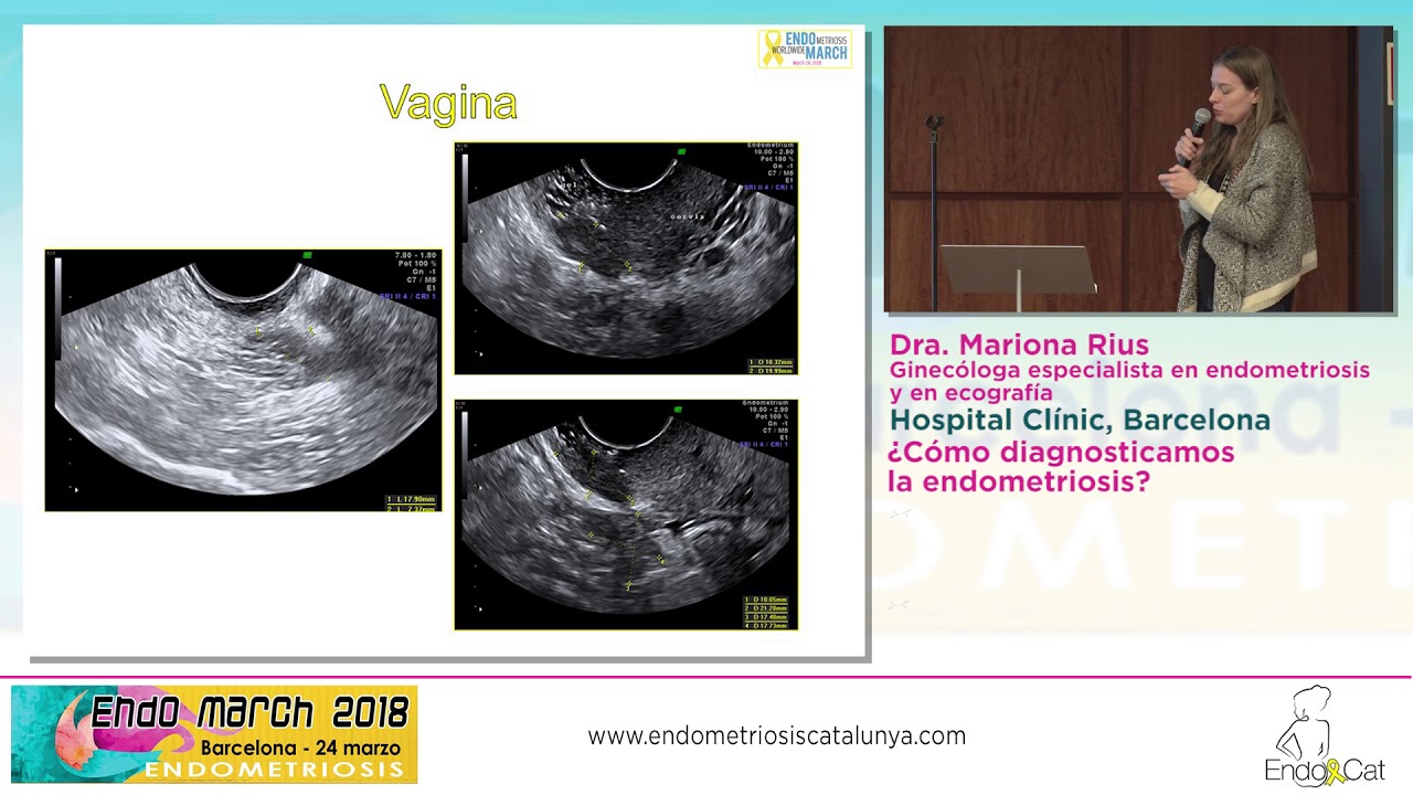 Dra. Mariona Rius: ¿Cómo diagnosticamos la Endometriosis?