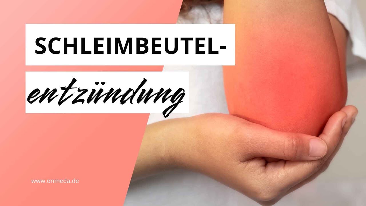 Schleimbeutelentz&uuml;ndung: Bursitis an Knie, Schulter & H&uuml;fte