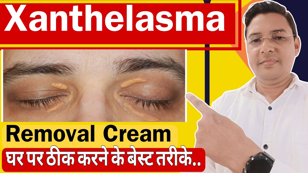 Xanthelasma Removal Cream || How to treat Xanthelasma home Remedies.