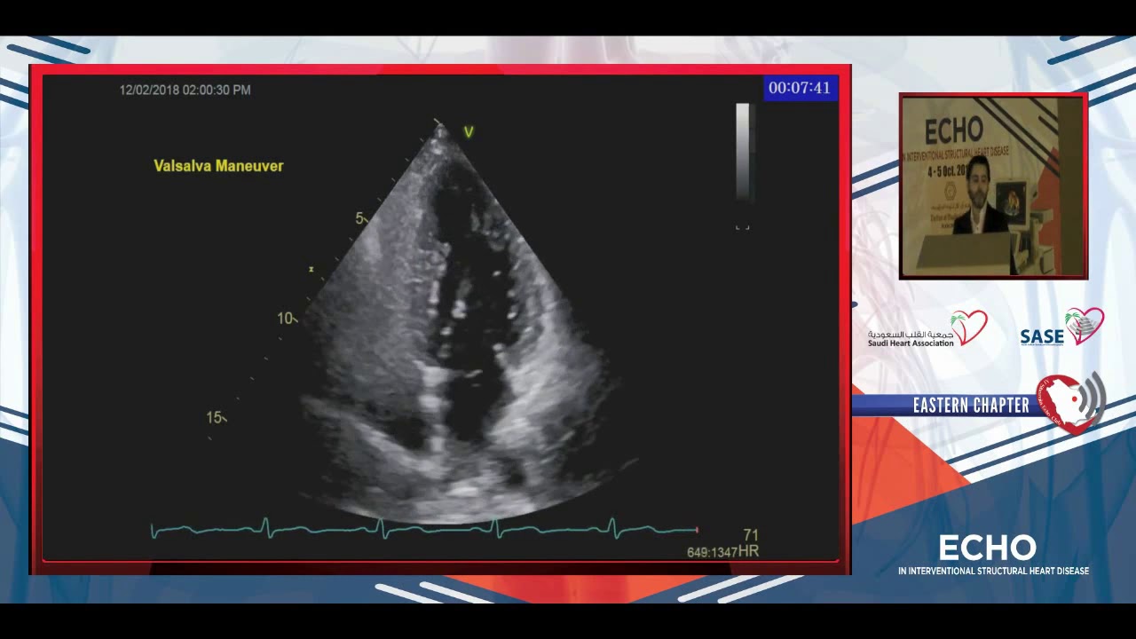Echocardiography for PFO closure