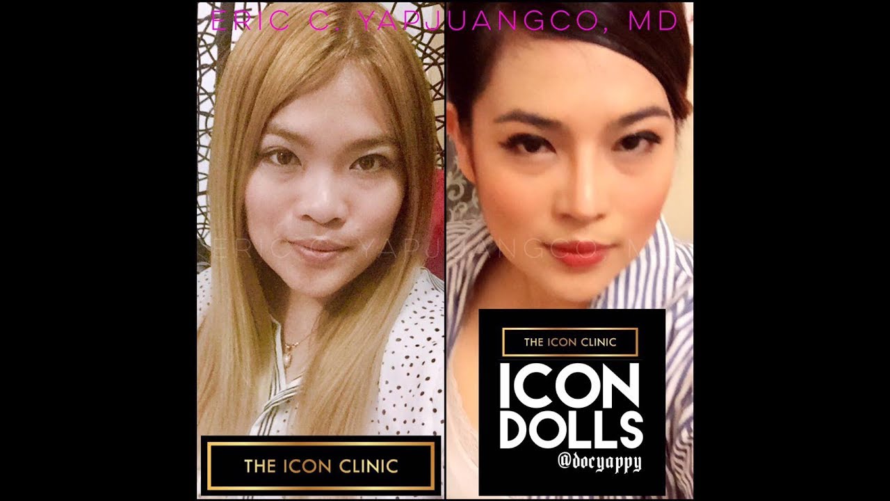 Nose Job - Asian Rhinoplasty #RealPeople #RealResults #IconDolls #IconWarriors #TheIconClinic