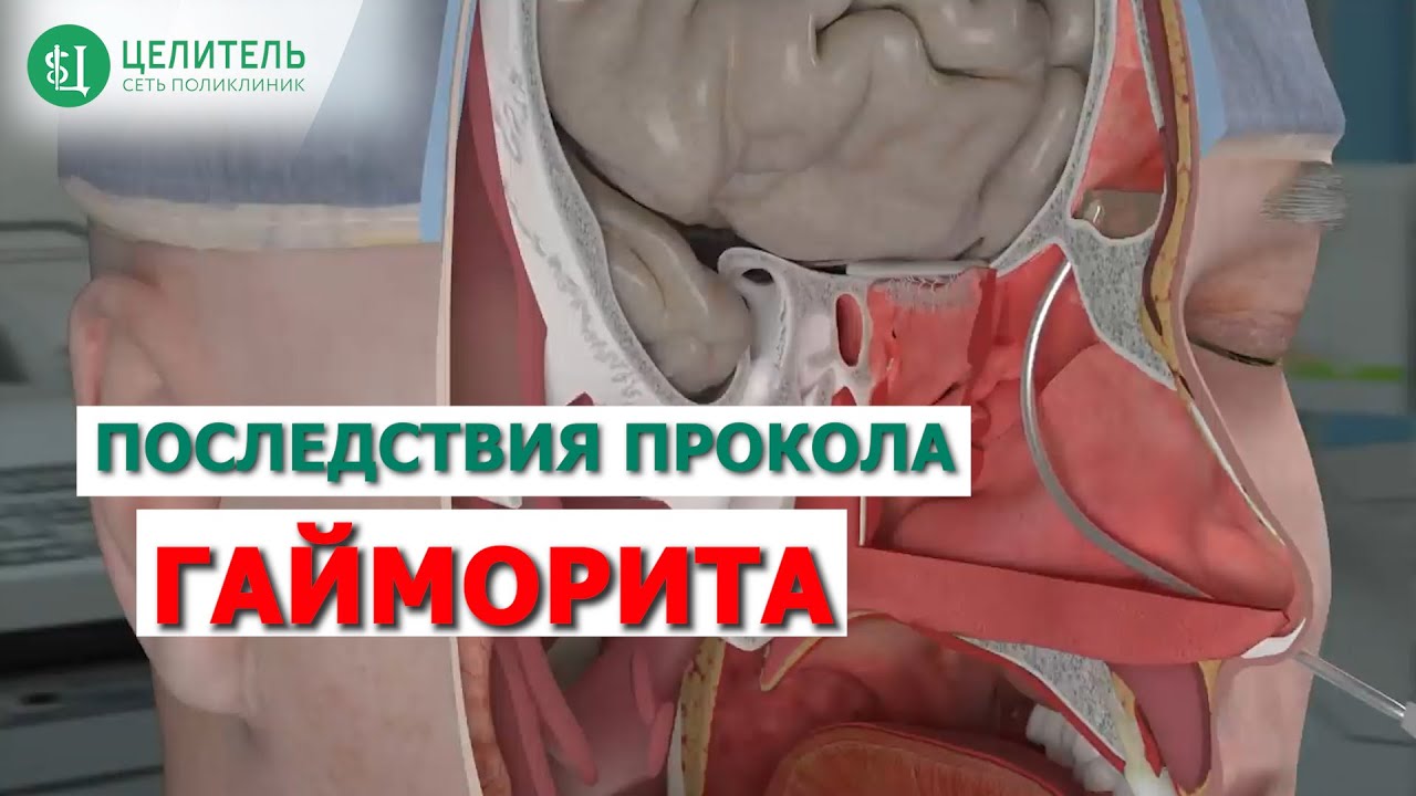 Пункция пазух носа. Что будет с костной тканью? Врач отоларинголог Магомедов Курбан Тимурович.