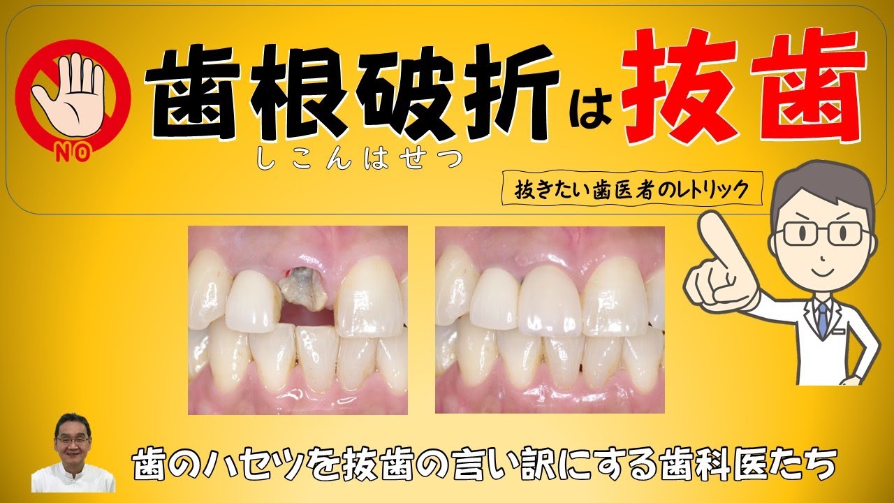 「歯根破折は抜歯」は、抜きたい歯科医のレトリック