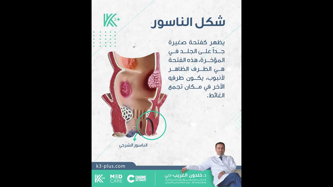 الناسور الشرجي أعراضه وعلاجه من الدكتور خلدون الغريب في دبي