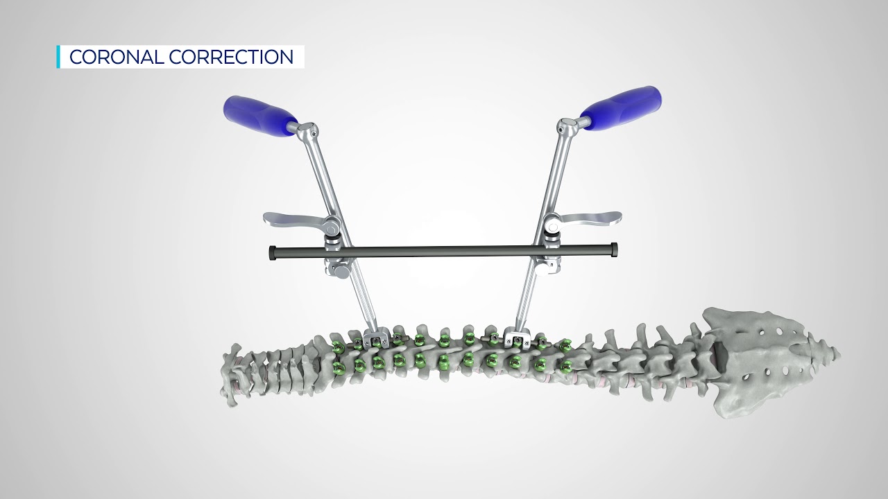 Globus Medical ROD LINK REDUCER Animation