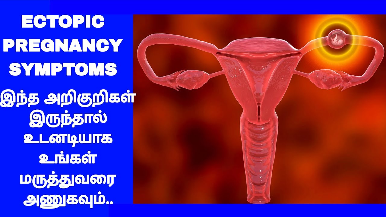Ectopic Pregnancy Symptoms || Ectopic கர்ப்பத்தின் தீவிர அறிகுறிகள் 