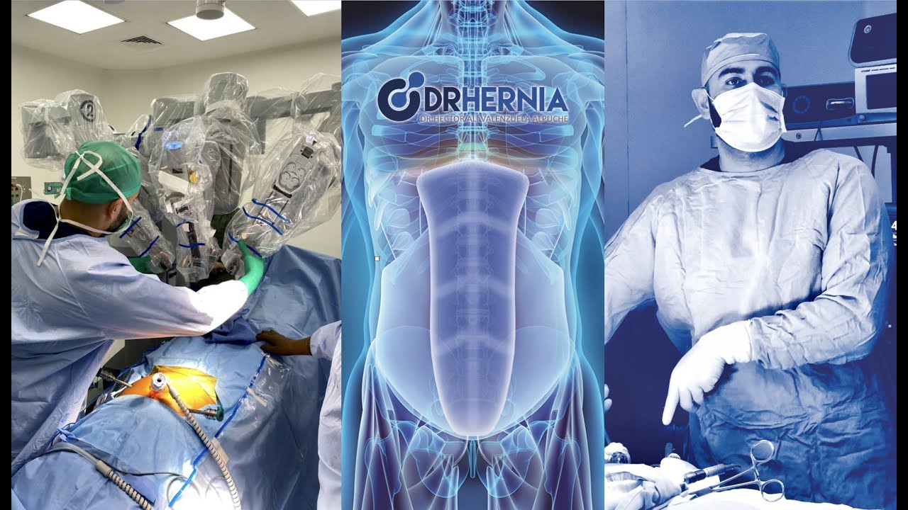 Testimonio Javier Hernandez, Cirugia Laparoscopica Hernia Inguinal Bilateral. Dr Hector Valenzuela