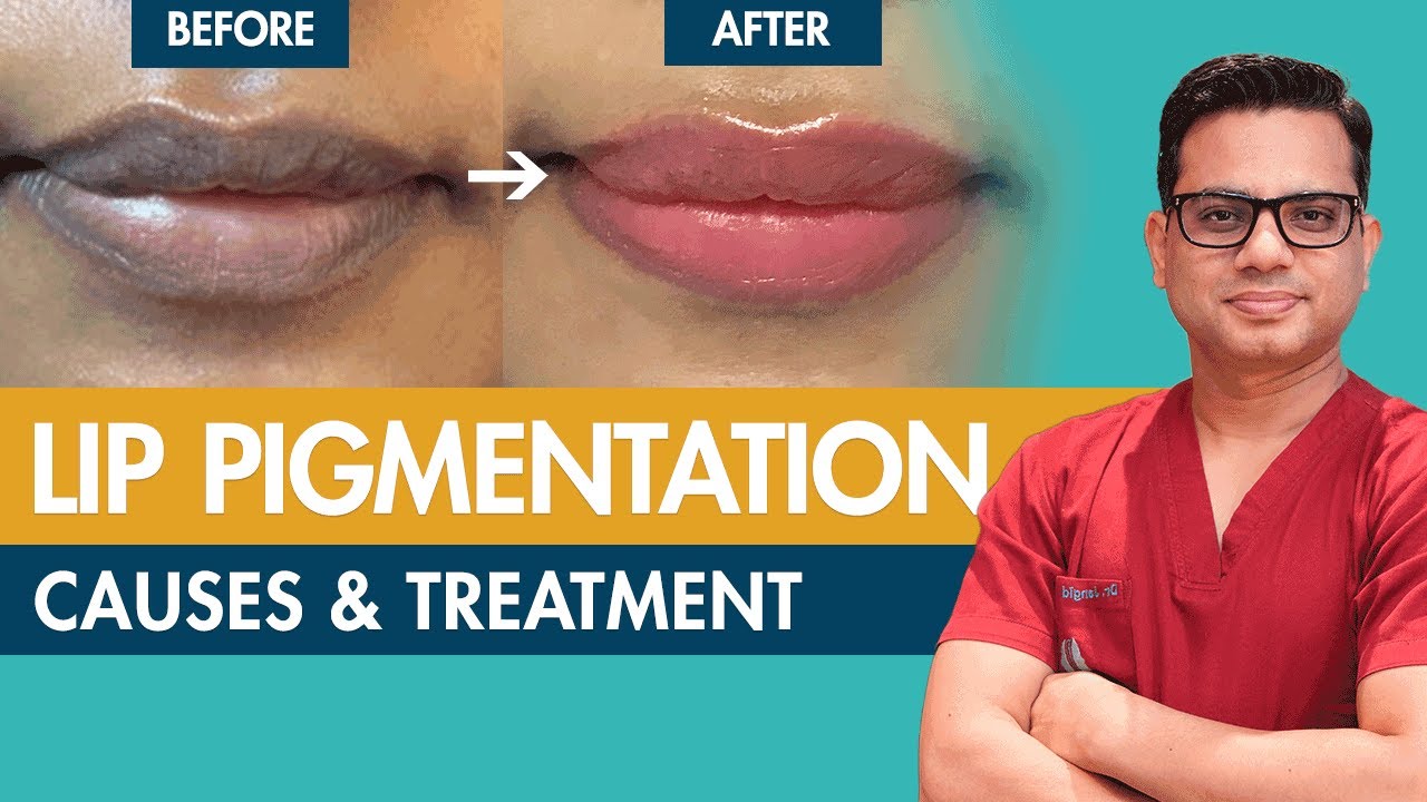 How to Get Pink Lips | Lighten Dark Lips | Lip Pigmentation Treatment | SkinQure