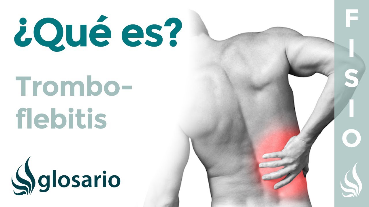 TROMBOFLEBITIS | Qu&eacute; es, qu&eacute; estructuras afecta, s&iacute;ntomas, causas y tratamiento fisioterap&eacute;utico