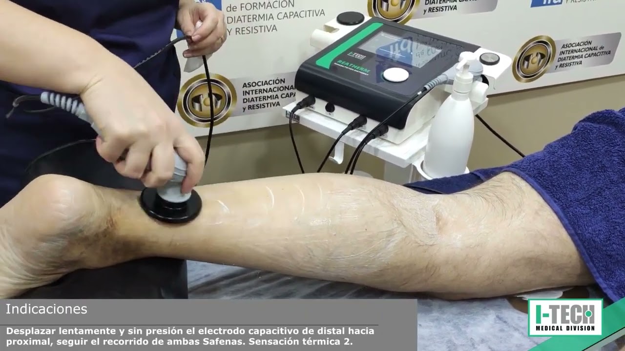 Diatermia Reatherm  edema de miembro inferior