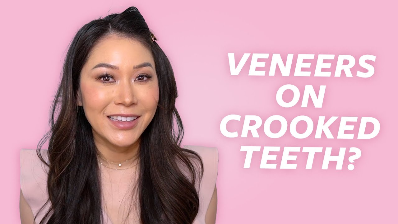 Can You Put Veneers on Crowded and Crooked Teeth? Dentist Explains | Dr. Joyce Kahng