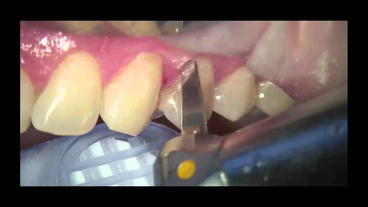 Dental Restorations with Renamel Flowable Microfill