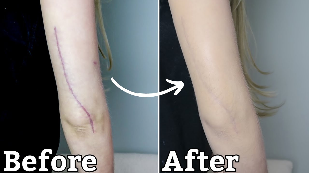 Как скрыть хирургический шрам