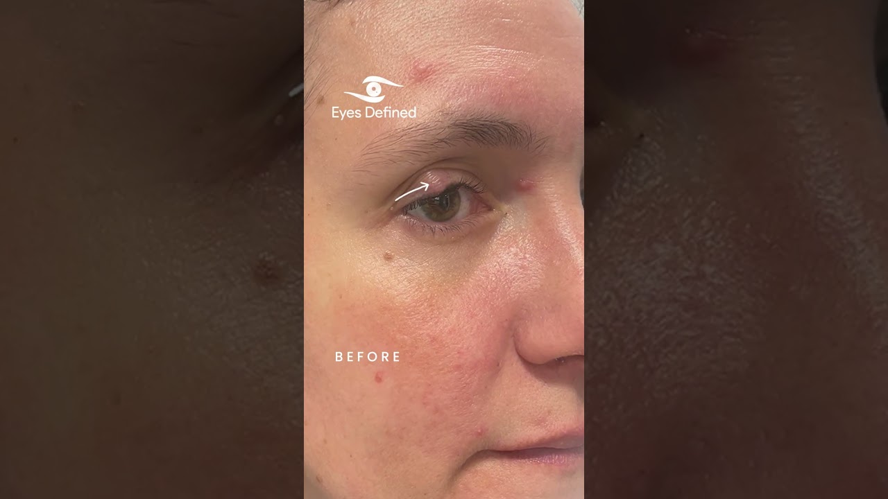 Large Right Upper Eyelid Chalazion Surgery 👁️✨